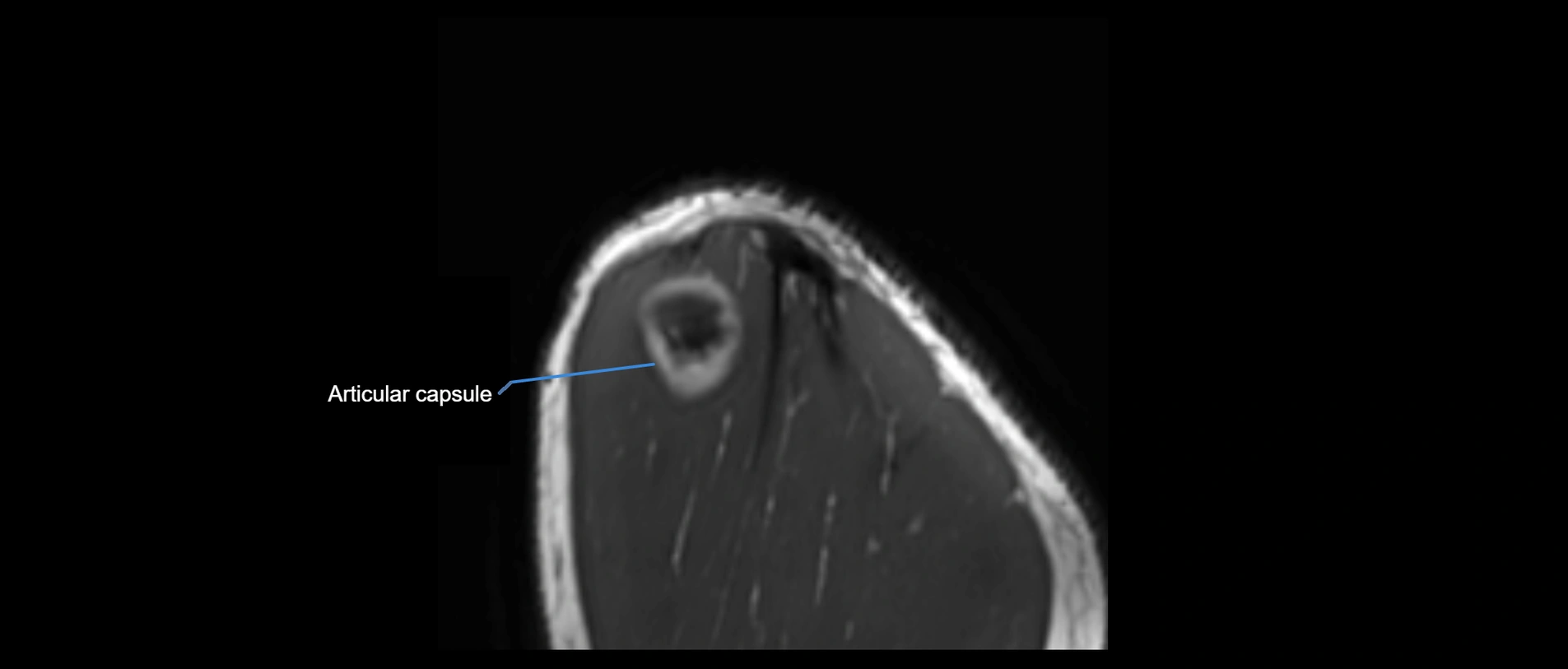 shoulder ligaments sagittal  cross sectional anatomy 3T MRI AI enhanced radiology image -img-00001-00057.webp